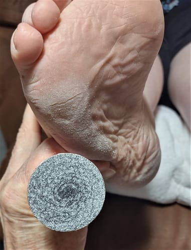 Customer photo review of Dermave™ Electric Foot Callus Remover