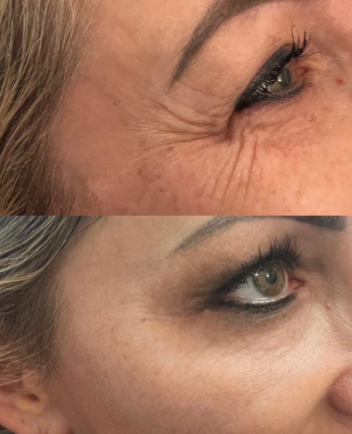 Customer photo review of Glov Serum-Infused Microneedle Eye Patches