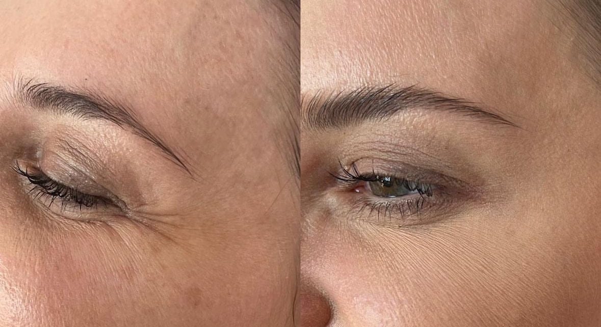 Customer photo review of Glov Serum-Infused Microneedle Eye Patches