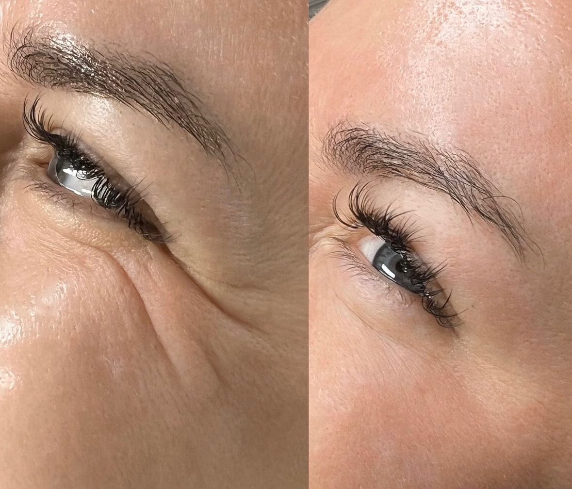 Customer photo review of Glov Serum-Infused Microneedle Eye Patches