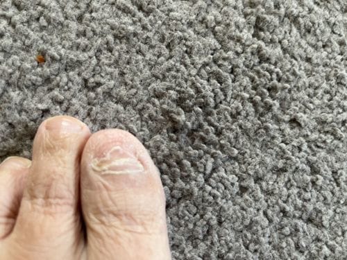 Customer photo review of Onychom Pro Antifungal LED Device