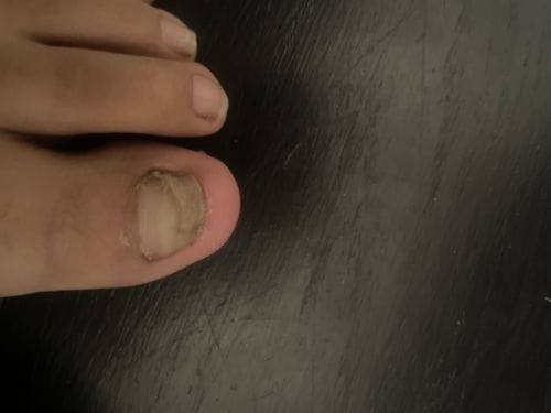 Customer photo review of Onychom Pro Antifungal LED Device