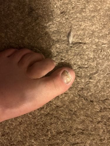 Customer photo review of Onychom Pro Antifungal LED Device