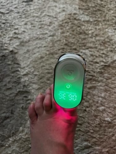 Customer photo review of Onychom Pro Antifungal LED Device