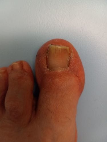 Customer photo review of Onychom Pro Antifungal LED Device