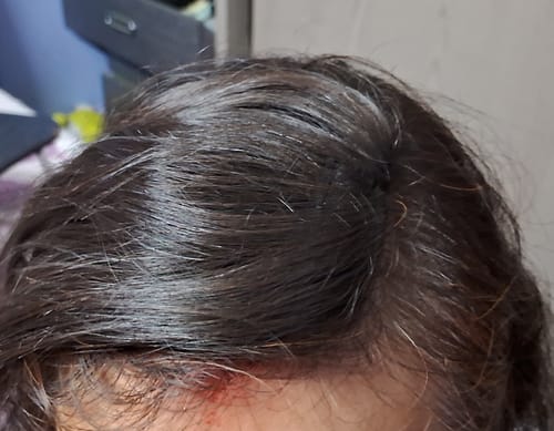 Customer photo review of INVISIBLE COVER-UP PATCH