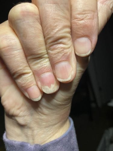 Customer photo review of Onychom Pro Antifungal LED Device