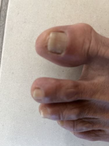 Customer photo review of Onychom Pro Antifungal LED Device