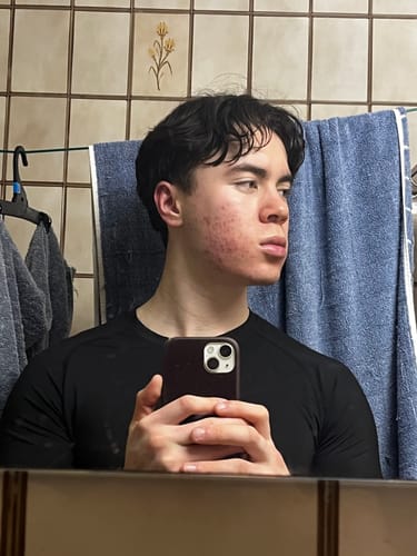 Customer photo review of Starter Acne Program™