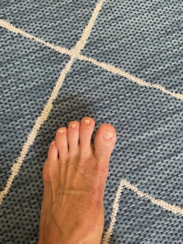 Customer photo review of Pentachom Photodynamic Laser Enhancer