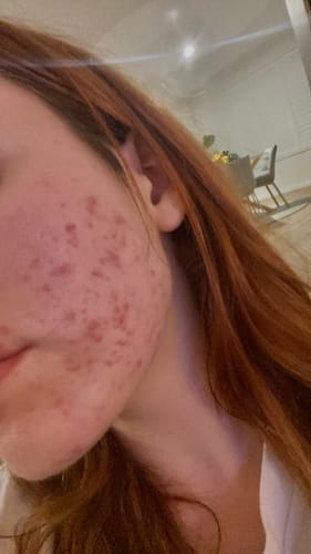 Customer photo review of Advanced Acne Program™
