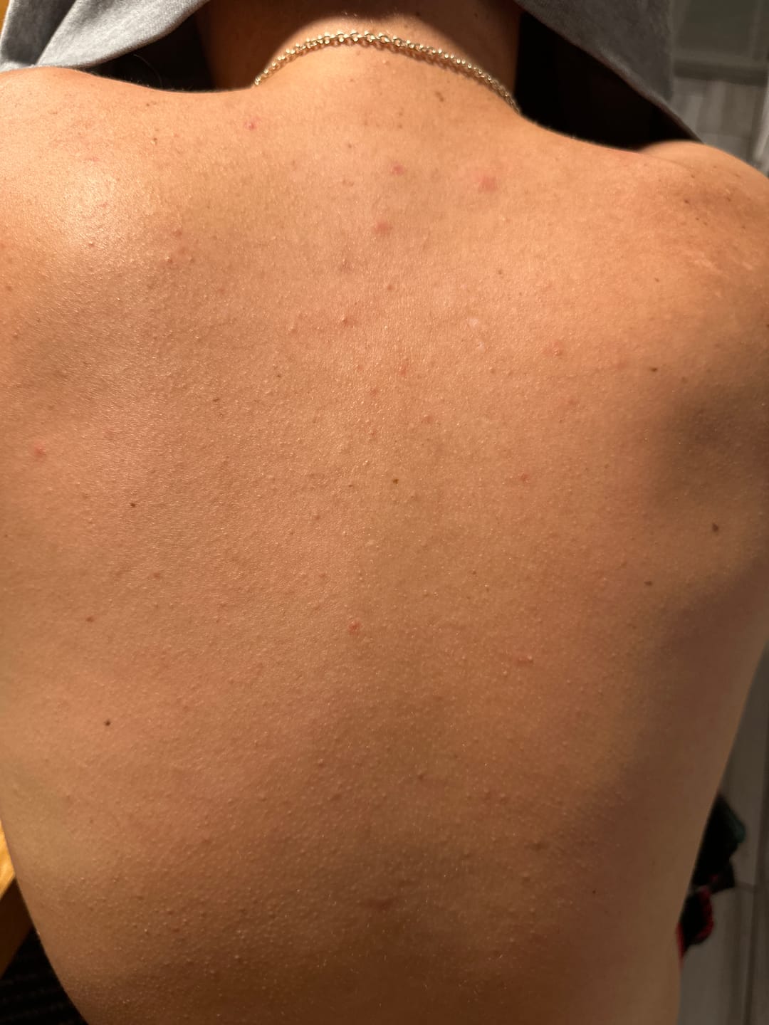 Customer photo review of Acne & Redness Killer