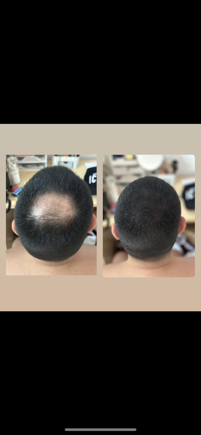 Customer photo review of Fibre copri Calvizie da 27.5gr | Nero | 60 Giorni di applicazioni