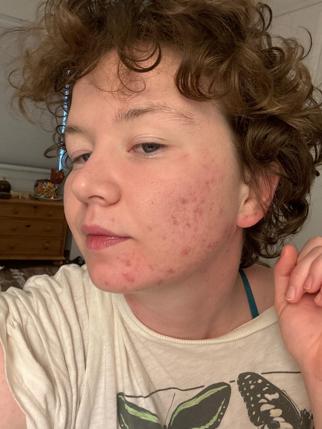 Customer photo review of The Complete Acne System for Women