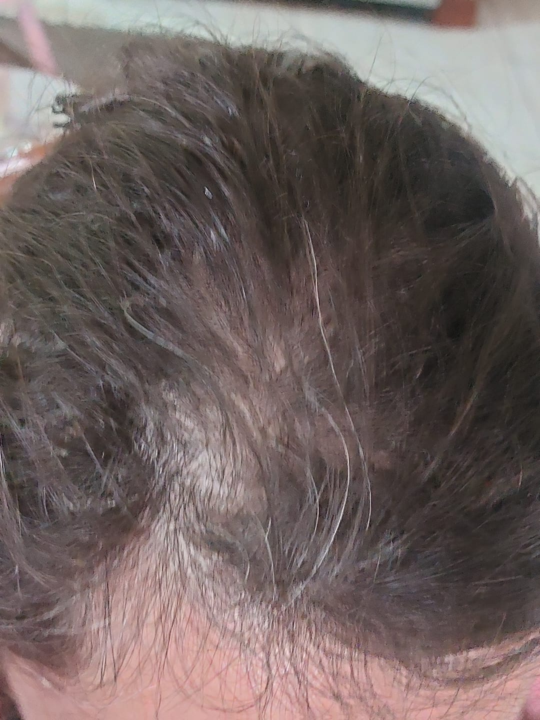 Customer photo review of 3 MESES de DÚO ANTIcaída CRECIMIENTO INTENSIVO Bomba + Tónico