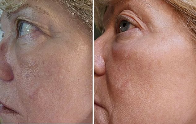 Customer photo review of LuminaLux Rejuvenate - 4 Color LED Mask