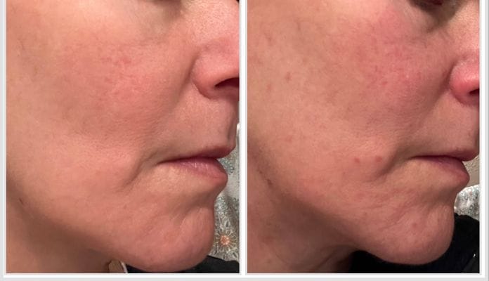 Customer photo review of LuminaLux Rejuvenate - 4 Color LED Mask