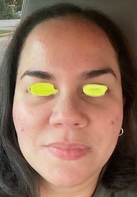 Customer photo review of LuminaLux Rejuvenate - 4 Color LED Mask