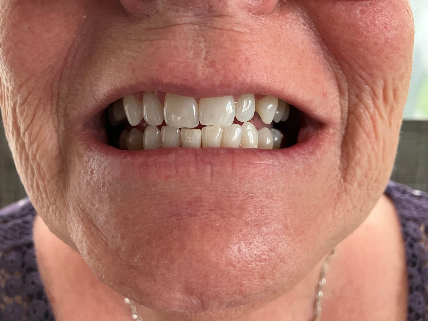 Customer photo review of Pack Bandes Violettes : 2 Paquets de Bandes Violettes Kauka Smile (sans peroxyde)