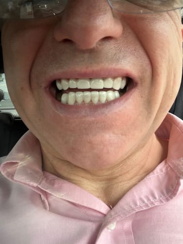 Customer photo review of Teeth-Veneer 2.0