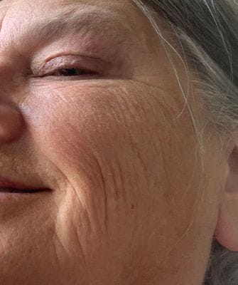 Customer photo review of LuminaLux Rejuvenate - 4 Color LED Mask