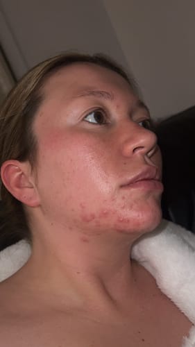Customer photo review of Advanced Acne Program™