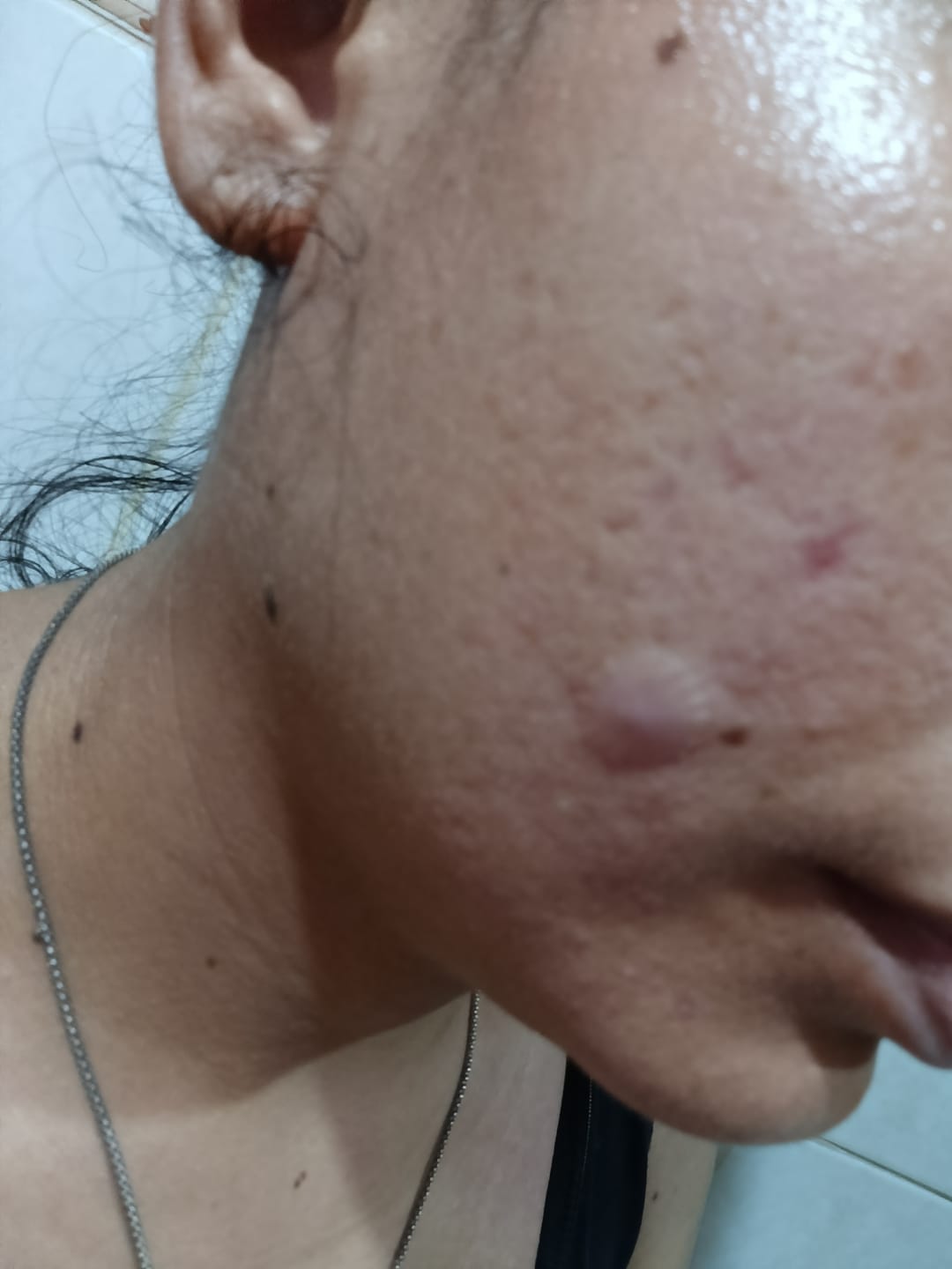 Customer photo review of SOME BY MI 30 Days Miracle Clear Spot Patch (18 parches)