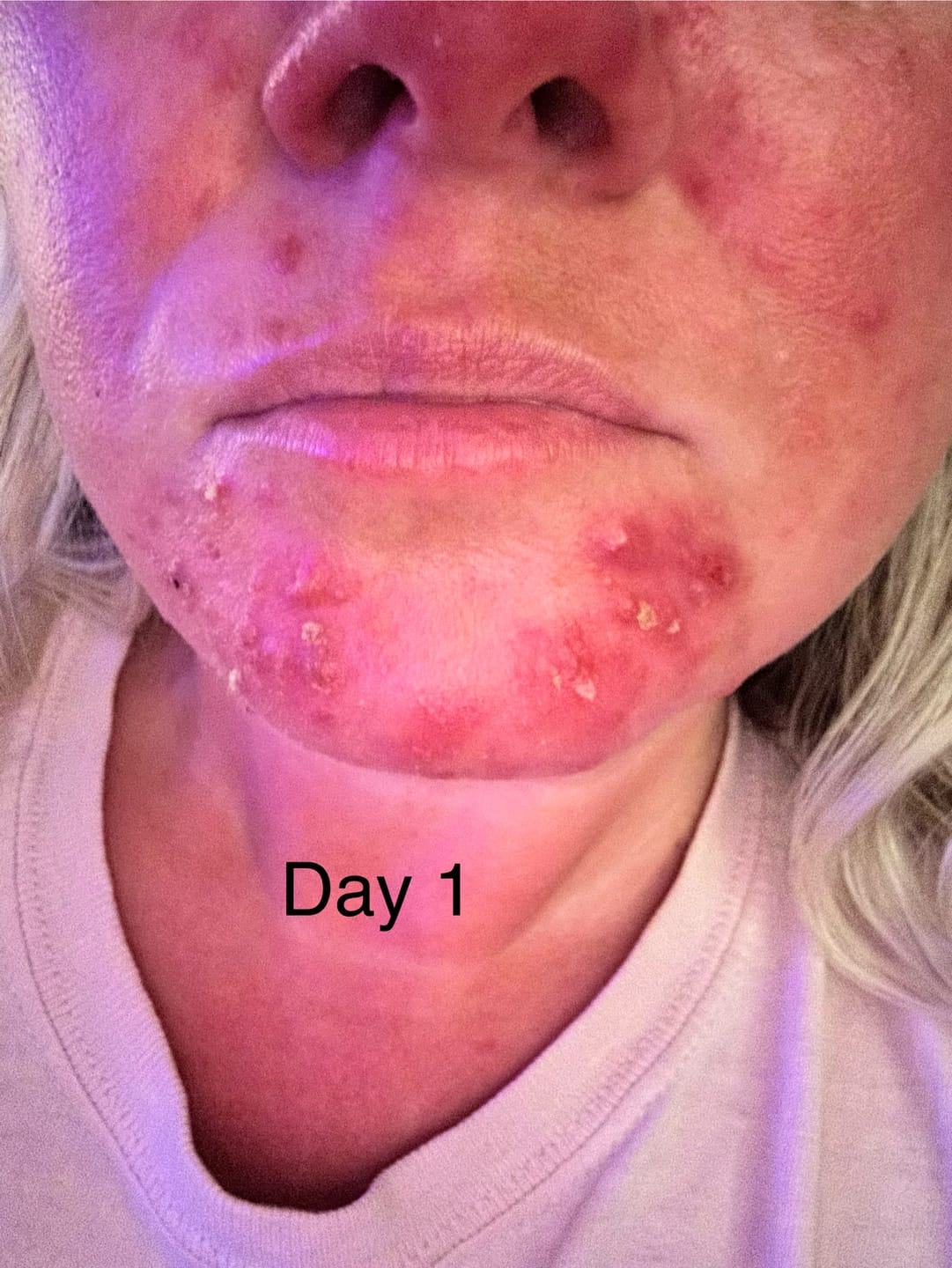 Customer photo review of The Complete Acne System for Women