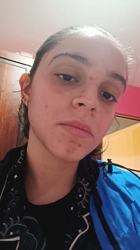 Customer photo review of AHA 30% + BHA 2% Peeling Solution 30 mL