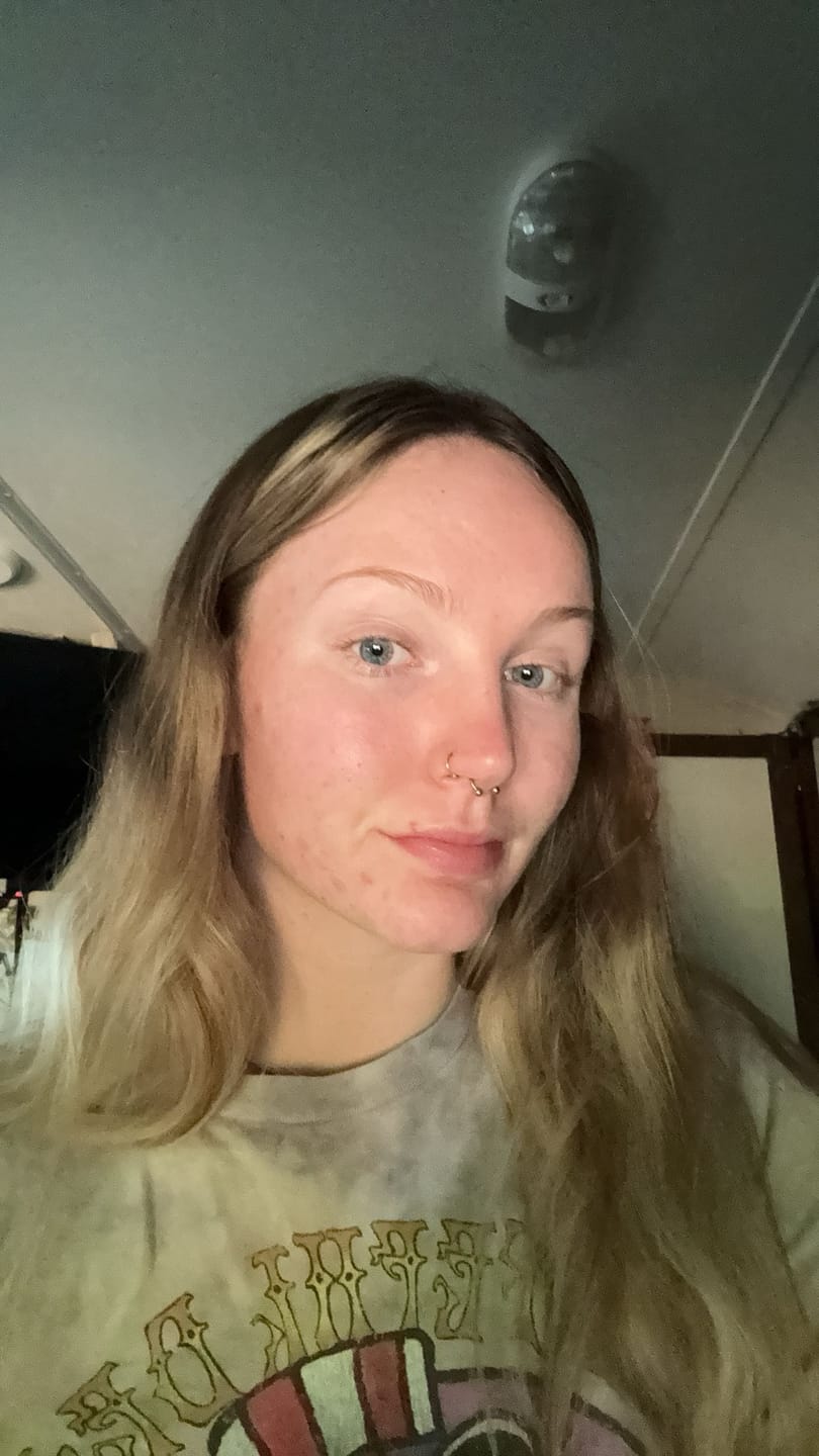 Customer photo review of The Complete Acne System for Women
