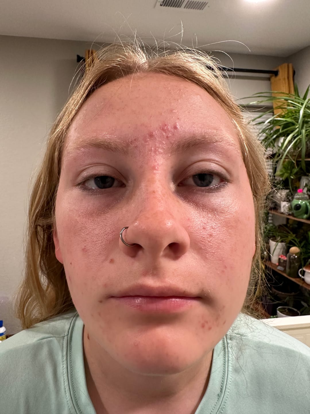 Customer photo review of The Complete Acne System for Women