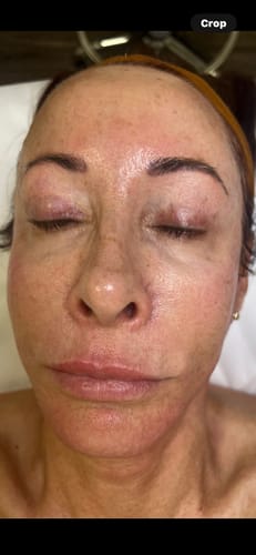 Customer photo review of Quick Fix Kit (Wrinkle Relaxer Serum & Hyaluronic Serum Sealer)
