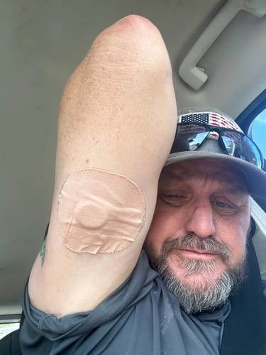 Customer photo review of Skin Tac Adhesive Barrier Wipes – Skin Grip