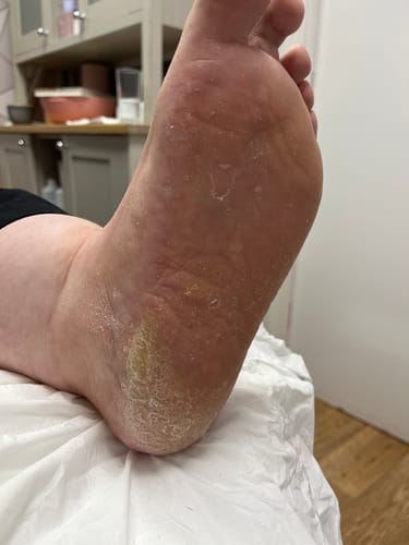 Customer photo review of LOVASKIN INSTANT FOOT PEEL - 500 ml Pro refill bottle - More than 125 callus removal treatments