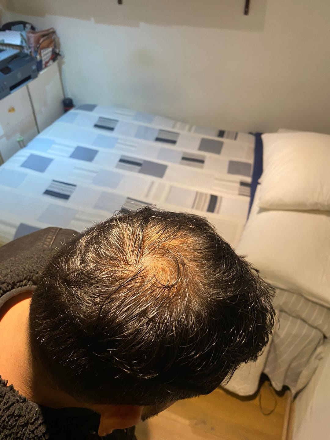 Customer photo review of PACK ANTICAÍDA DE CABELLO PARA 3 MESES