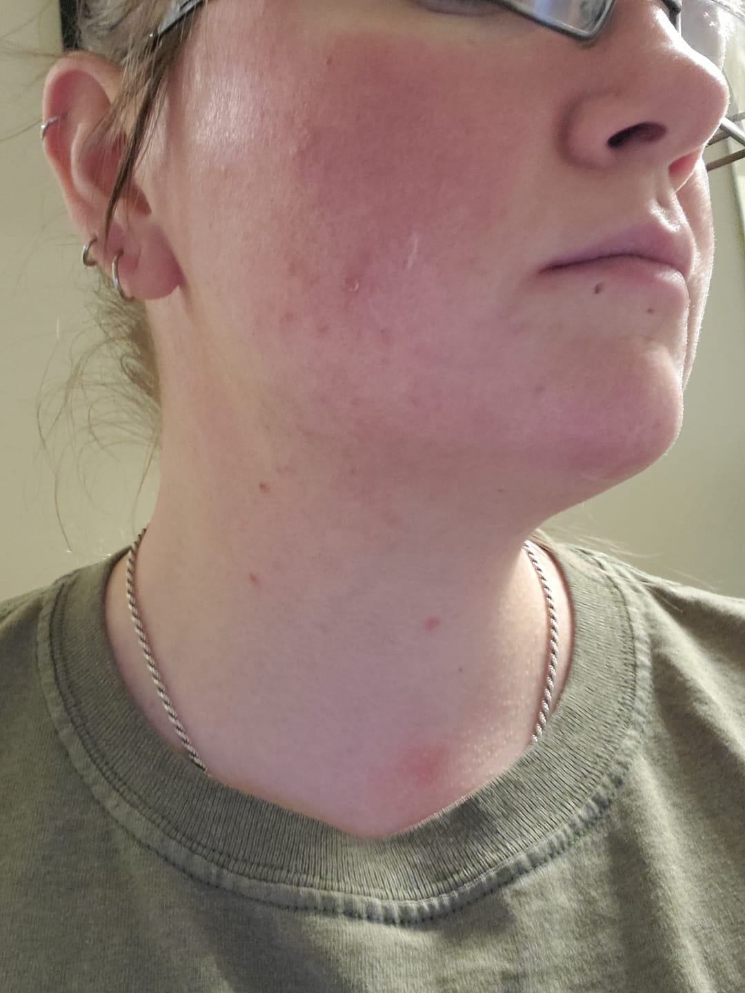 Customer photo review of The Complete Acne System for Women
