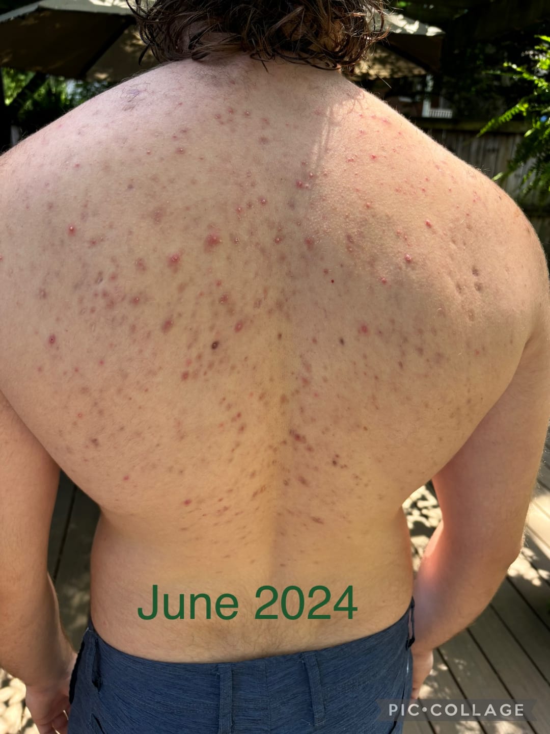 Customer photo review of Acne & Redness Killer