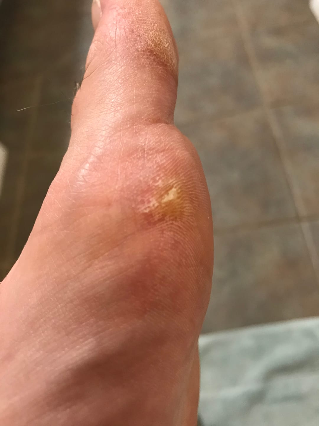 Customer photo review of The Wartabater | Electronic Wart Remover | Safe, Easy, & Effective