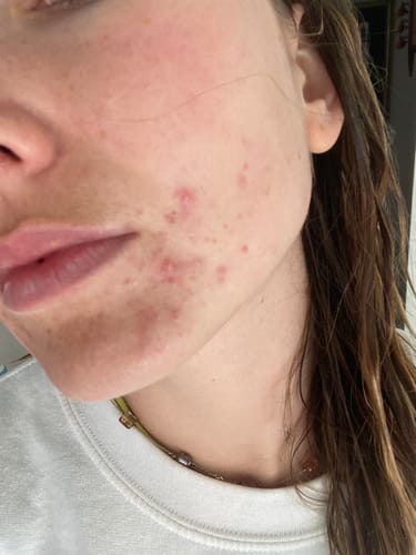 Customer photo review of Advanced Acne Program™