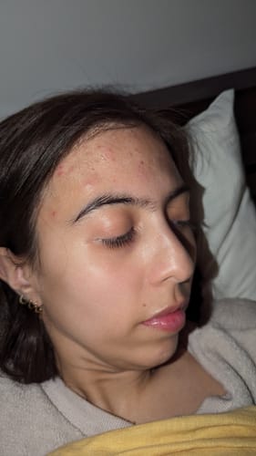 Customer photo review of Advanced Acne Program™