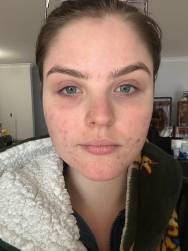 Customer photo review of Intermediate Acne Program™