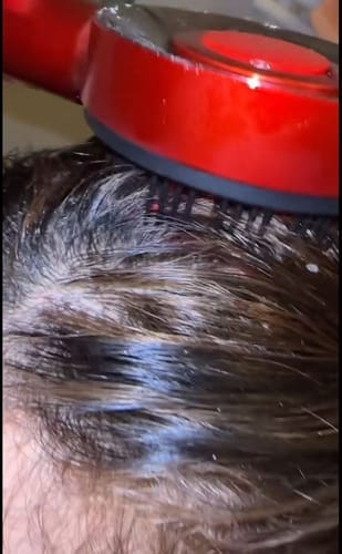 Customer photo review of Glowera™ 3 in 1 Red Light Scalp Massager