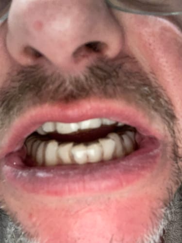 Customer photo review of SleepPro Hard Night Guard 3mm