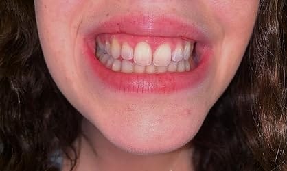 Customer photo review of Snow Smile ultimate hampaiden valkaisusarja
