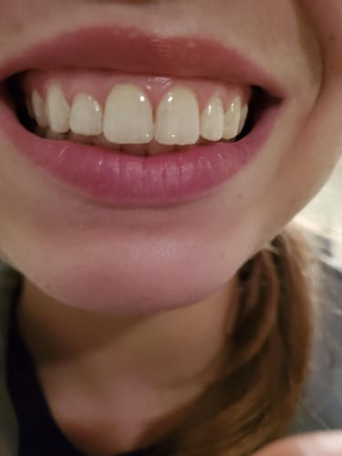Customer photo review of Snow Smile ultimate hampaiden valkaisusarja