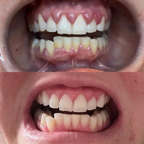 Customer photo review of Snow Smile ultimate hampaiden valkaisusarja