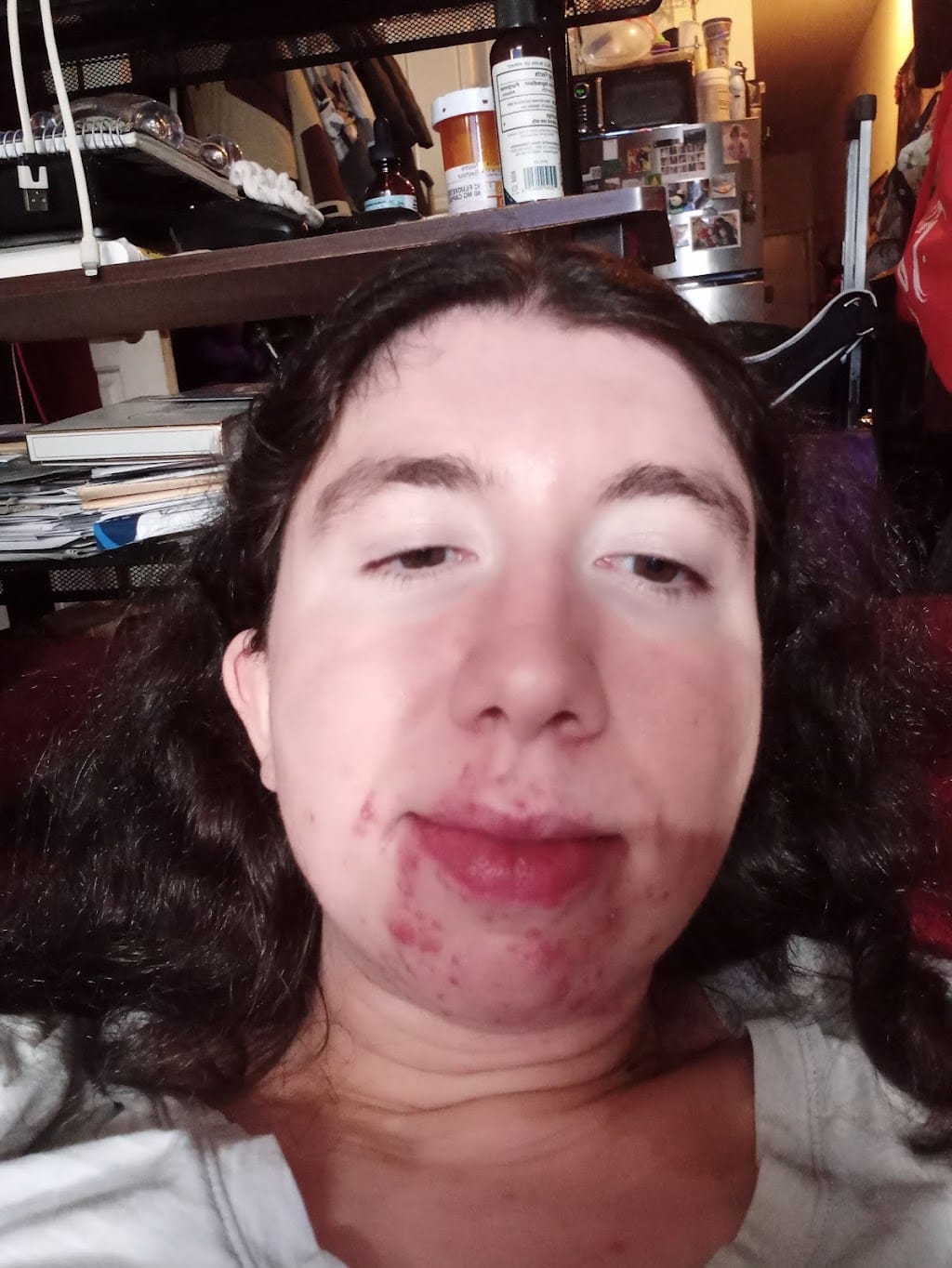 Customer photo review of The Complete Acne System for Women
