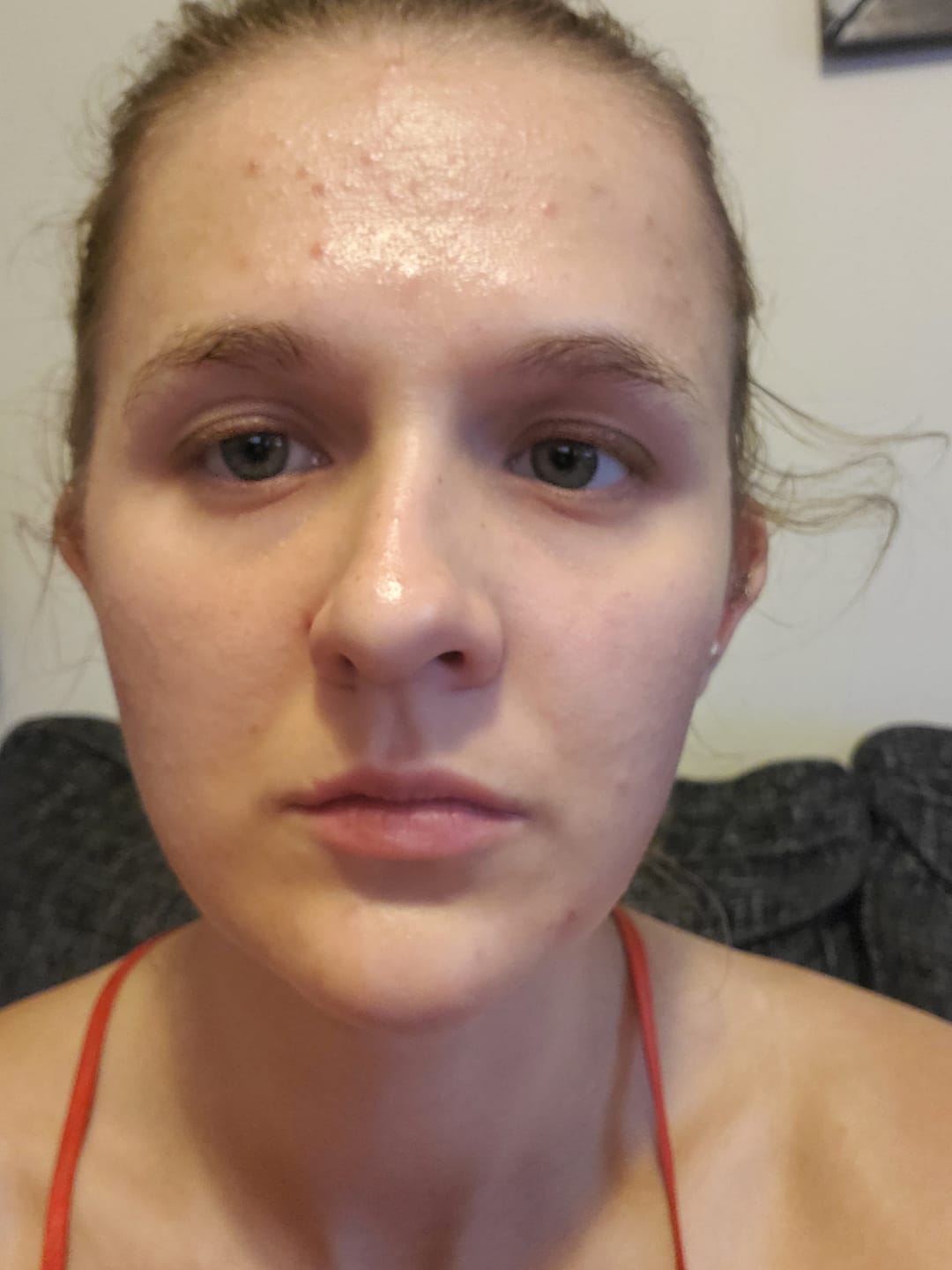 Customer photo review of The Complete Acne System for Women