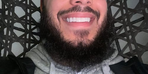 Customer photo review of Teeth-Veneer 2.0