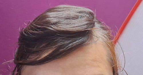 Customer photo review of INVISIBLE COVER-UP PATCH